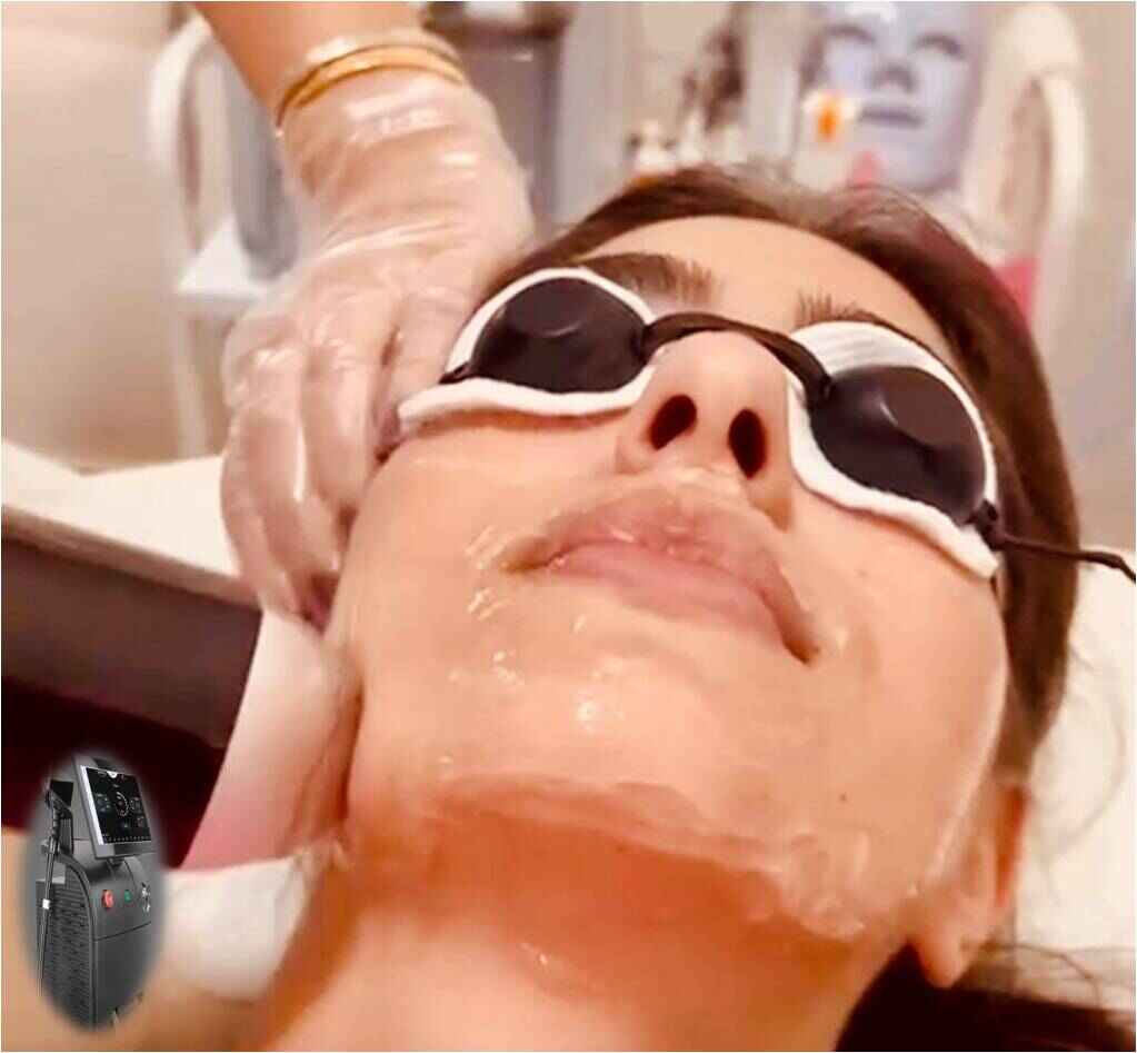 Laser Hair Removal - Alma Soprano Ice Titanum in Mastita Blat Jbeil (Byblos)